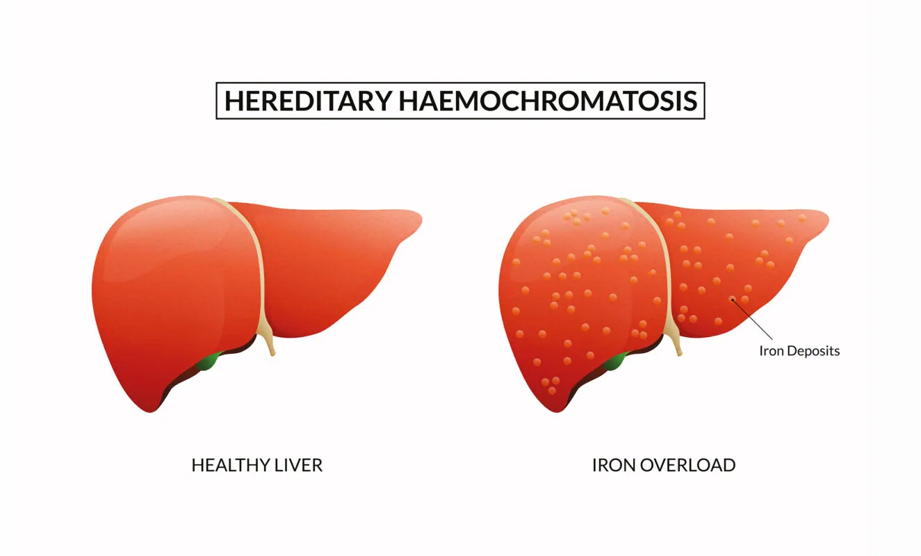 Haemochromatosis, or Iron Overload Disorder. article image